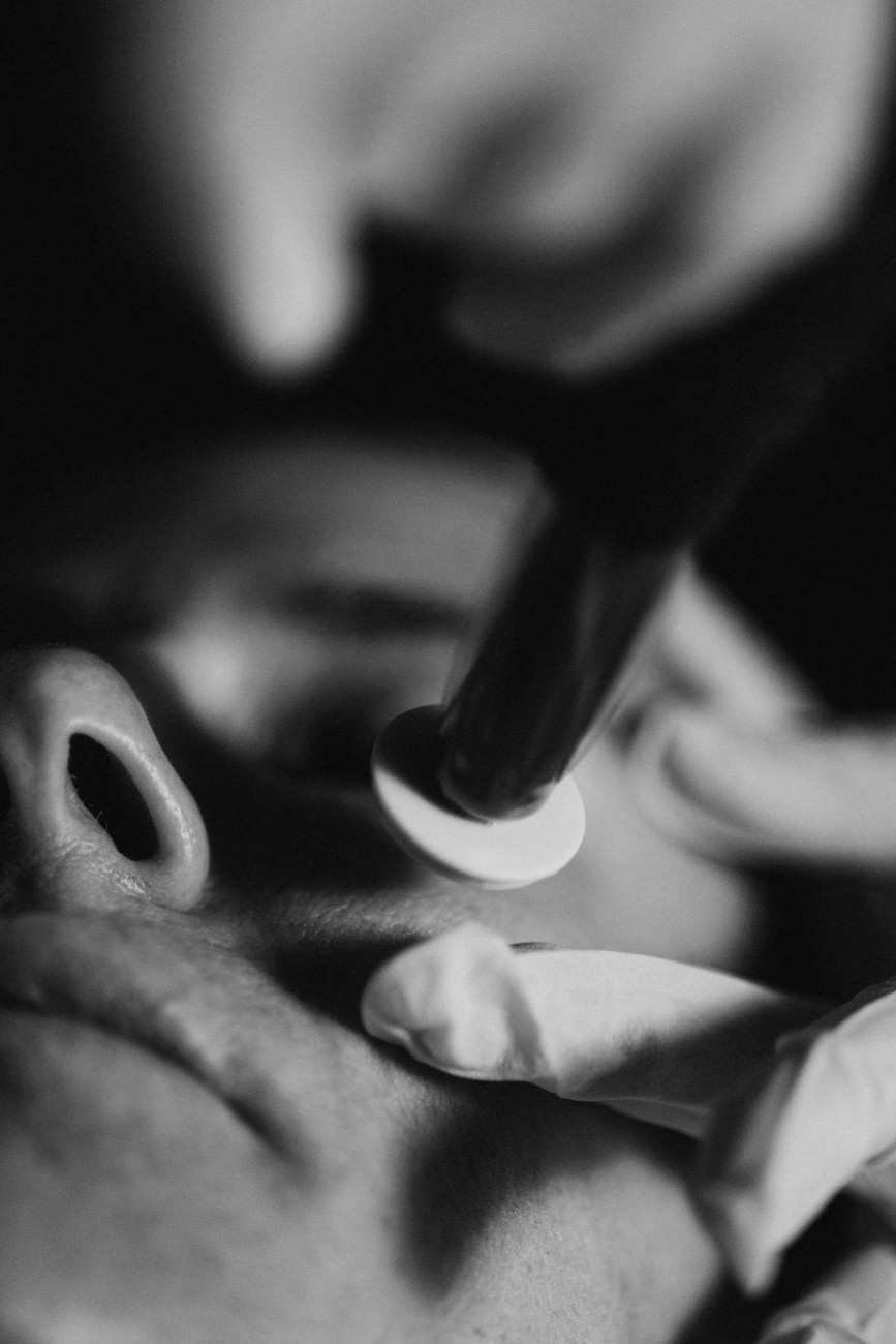 Procell Microchanneling Treatment